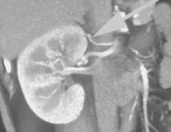 Renal Artery Branch to Upper Pole of the Kidney - CTisus CT Scan