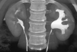 Mild Ureteropelvic Junction (UPJ) Obstruction - CTisus CT Scan