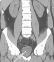 Passed Stone in the Bladder - CTisus CT Scan