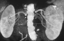 Stenosis of the Origin of the Left Renal Artery - CTisus CT Scan