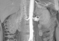 2nd Artery to the Upper Pole of the Left Kidney - CTisus CT Scan