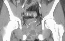 Prostate Abscess Due to Tuberculosis (TB) - CTisus CT Scan