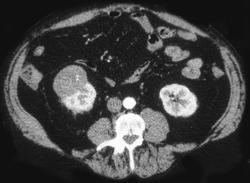 Renal Carcinoma - CTisus CT Scan