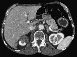 Renal Lymphoma - CTisus CT Scan