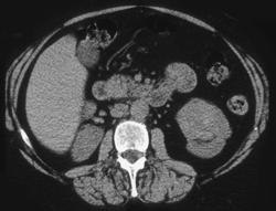 Renal Carcinoma - CTisus CT Scan