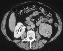 Renal Carcinoma - CTisus CT Scan