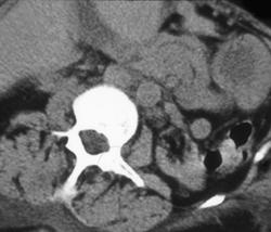 Carcinoma in End Stage Renal Disease - CTisus CT Scan