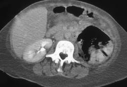 Emphysematous Pyelonephritis - CTisus CT Scan