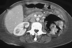 Emphysematous Pyelonephritis CT and Ultrasound - CTisus CT Scan