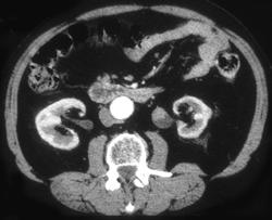 Transitional Cell Carcinoma of the Left Renal Pelvis - CTisus CT Scan