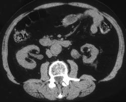 Transitional Cell Carcinoma - CTisus CT Scan