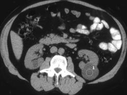 Renal Cyst - CTisus CT Scan