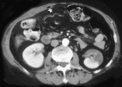 Renal Infarct - CTisus CT Scan