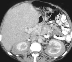 Extramedullary Hematopoesis Simulates Lymphoma - CTisus CT Scan