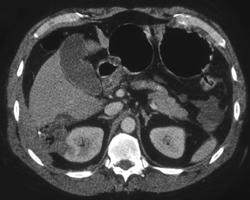 Liver Laceration in Patient S/P Cryoablation of A Renal Mass - CTisus CT Scan