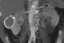 Type 3 Bosniak Cyst With Calcification - CTisus CT Scan