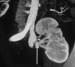 Stenosis of the Lower Pole Artery of A Renal Transplant - CTisus CT Scan