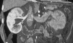 Renal Cell Carcinoma Invades the Renal Vein - CTisus CT Scan