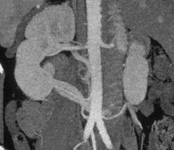 Duplication of the Renal Veins - CTisus CT Scan