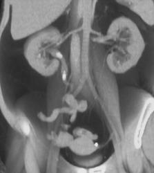 Multiple Stones in the Left Renal Pelvis and Ureter - CTisus CT Scan