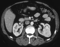 Left Renal Cell Carcinoma - CTisus CT Scan