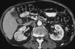 Right Hypervascular Renal Cell Carcinoma - CTisus CT Scan