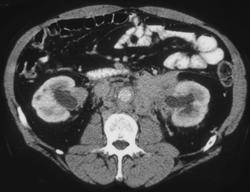 Lymphoma Infiltrates Both Renal Hila - CTisus CT Scan