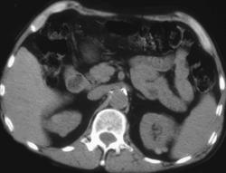 High Density Renal Cysts - CTisus CT Scan