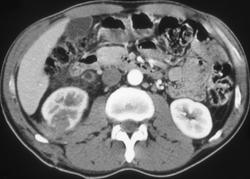 Renal Laceration S/P Failed Stent Placement W/ Blood in Renal Pelvis - CTisus CT Scan