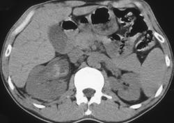 Hemorrhage in Right Renal Pelvis - CTisus CT Scan