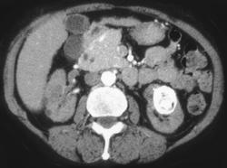 Calcified Left Renal Carcinoma - CTisus CT Scan