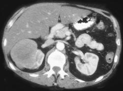 Renal Lymphoma - CTisus CT Scan