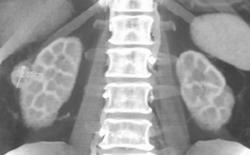 Renal Cell Carcinoma - CTisus CT Scan