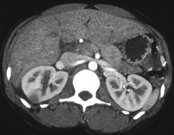 Acute Pyelonephritis - CTisus CT Scan