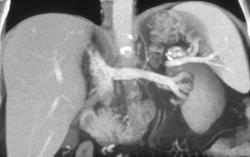 Normal Left Renal Vein - CTisus CT Scan