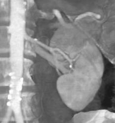 Plaque on Left Renal Artery - CTisus CT Scan