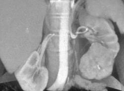 Renal Call Cancer- Not Candidate for A Partial Nephrectomy - CTisus CT Scan