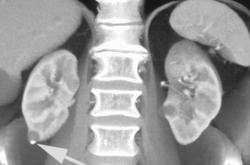 Renal Cysts. Cyst on Right Kidney Has Calcification - CTisus CT Scan