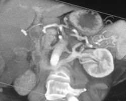 Retro-aortic Renal Vein - CTisus CT Scan