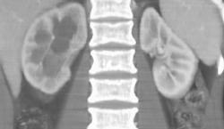 Dilated Renal Pelvis - CTisus CT Scan