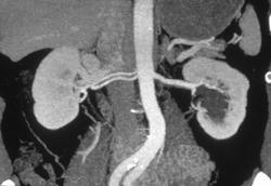 2 Right Renal Arteries - CTisus CT Scan