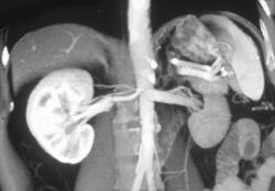 Nice Polar Renal Artery - CTisus CT Scan