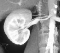 Nice Polar Renal Artery - Kidney Case Studies - CTisus CT Scanning