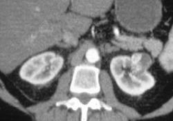 Cystic Renal Cell Carcinoma - CTisus CT Scan