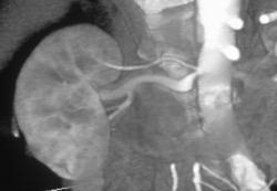 Nice Polar Renal Artery W/ Common Origin Seen W/ VRT & MIP Display - CTisus CT Scan