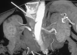 Polar Left Renal Artery - CTisus CT Scan