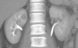 Focal Pyelonephritis Right Kidney - CTisus CT Scan