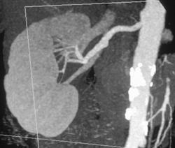 Normal Renal Artery - CTisus CT Scan