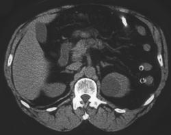 Renal Cyst- Bosniak I - CTisus CT Scan