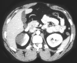 Renal Infarction - CTisus CT Scan